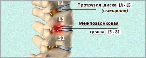 Поясничная грыжа позвоночника Грыжа и протрузия